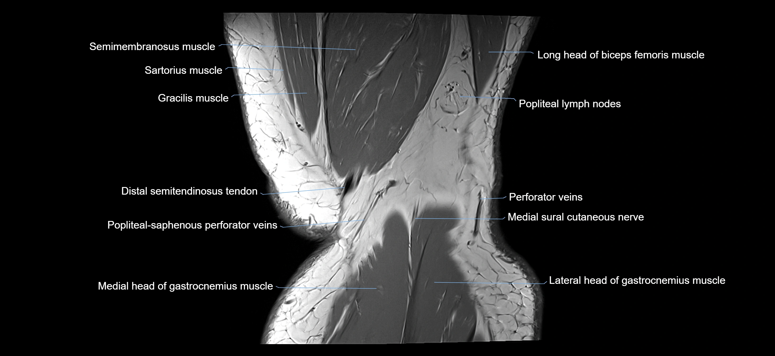 MRI knee coronal cross sectional anatomy labelled 3T radiology  image-04001-00042.webp